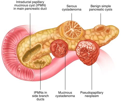 59 Pancreas Congenital Cysts Maude Abbott Medical Museum Mcgill University