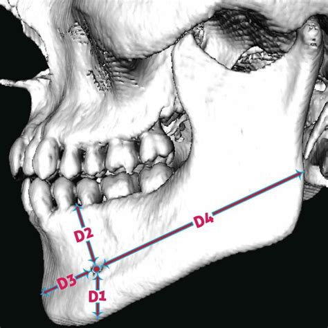 Illustrating The Position Of The Mental Foramen And The Distances