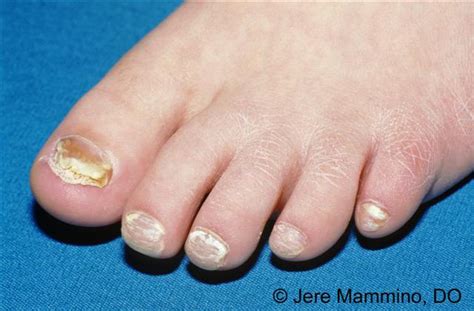 Tinea Pedis Types