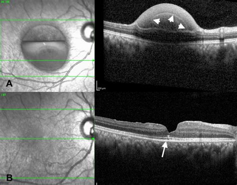 SD OCT On Presentation A Showing A Dome Shaped Lesion Showing That