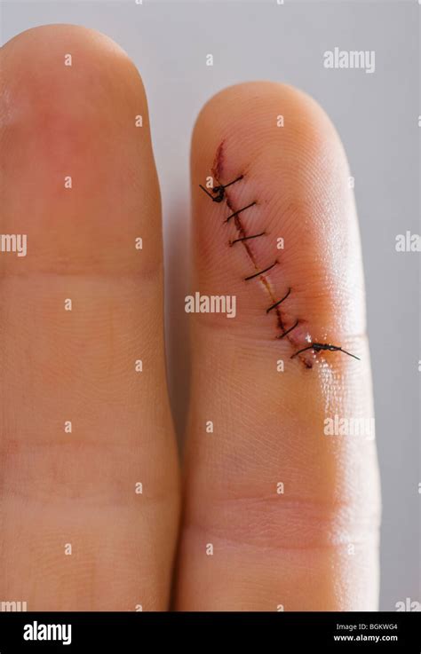 Finger Cut Stitches