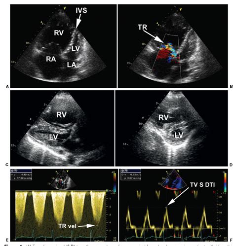 Figure 1 From Diagnosis And Hemodynamic Assessment Of Pulmonary