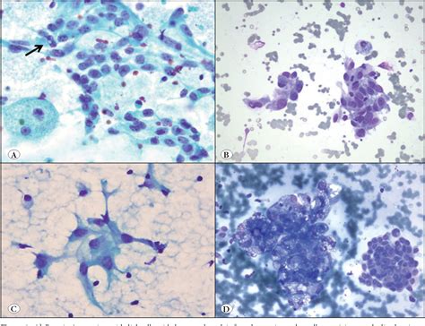 Figure 1 From Pitfalls In The Cytological Assessment Of Thyroid Nodules Semantic Scholar