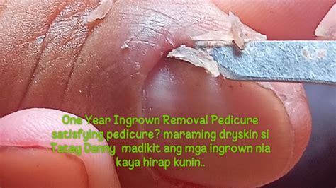 Part One Year Ingrown Removal Pedicure Satisfying Pedicure May