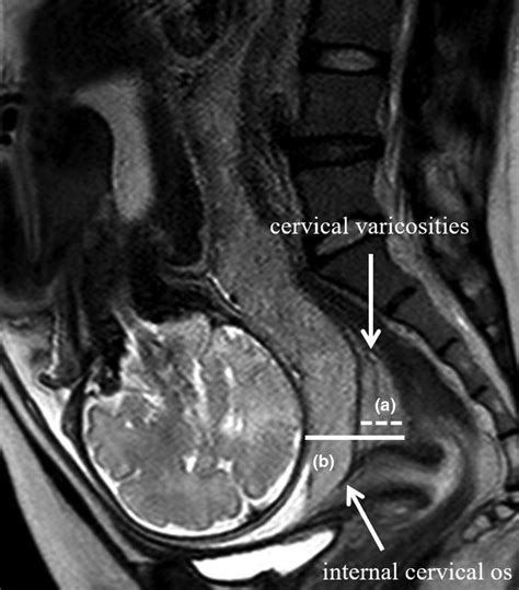 The Use Of Magnetic Resonance Imaging To Predict Placenta Previa With