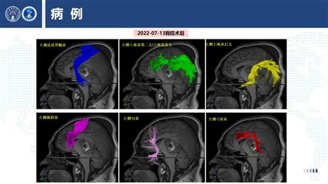 上海长海医院神经外科：丘脑巨大胶质瘤诊断及手术的精准理念 脑医汇 神外资讯 神介资讯