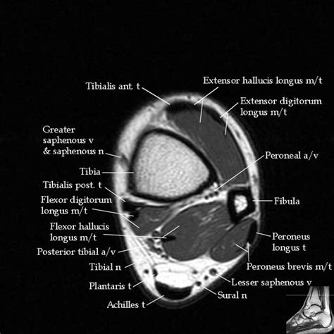 Knee Muscle Anatomy Mri / Thigh Muscle Anatomy Mri | Anatomía, Musculos ...