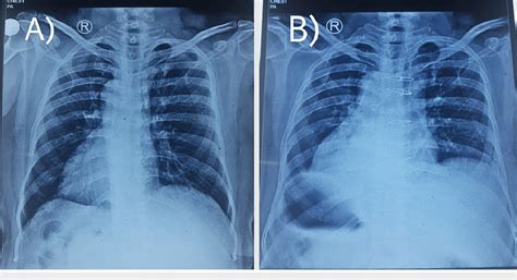 A Chest Roentgenogram Showing Dextrocardia B Chest Roentgenogram