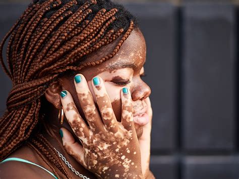 Overcoming Vitiligo Stigma