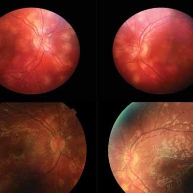 Medical Treatment Of Hla B Positive And Negative Anterior Uveitis