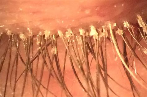 Blepharitis — Moyes Eye Center