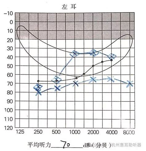 重庆渝北加州惠耳听力助听器验配服务中心：助听器反复调不好，还有这种可能！ 知乎