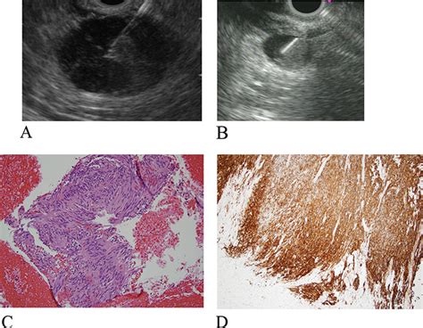 Role Of Endoscopic Ultrasound In Subepithelial Lesions Sels Intechopen