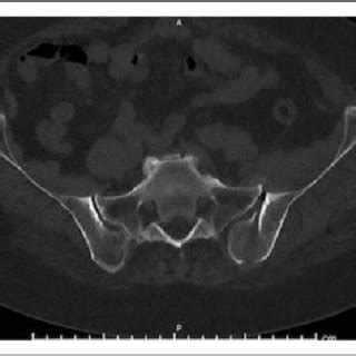 Axial Ct Scan Of The Same Patient In Figure Illustrating The