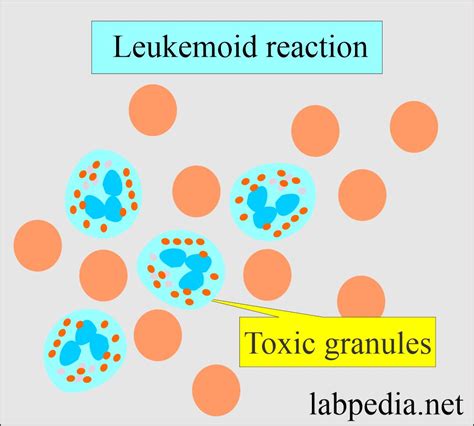 Leukemoid Reaction and Diagnosis (D/D from Chronic Myelocytic leukemia ...