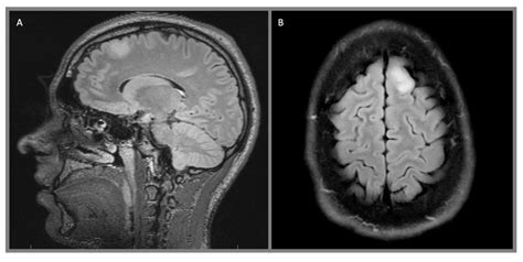 Cancers Free Full Text Pediatric Low Grade Gliomas