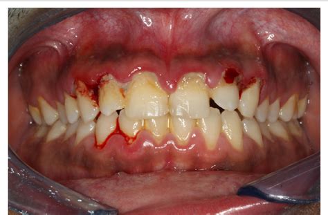 Figure From Necrotizing Ulcerative Gingivitis In The Setting Of