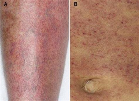 What causes low platelets? – What causes this?