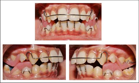 Indian Board Of Orthodontics Case Report Management Of A Skeletal Cl