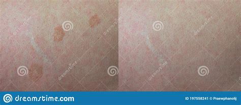 Tinea Versicolor Before And After