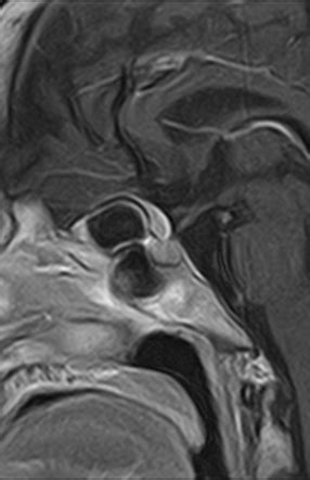 Planum Sphenoidale Meningioma Radiology Case Radiopaedia Org