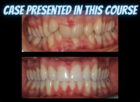 Class Ii Treatments With Clear Aligners The Clear Institute