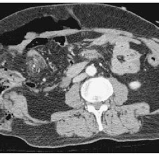 Preoperative Abdominal Computed Tomography Ct Scan Demonstrating