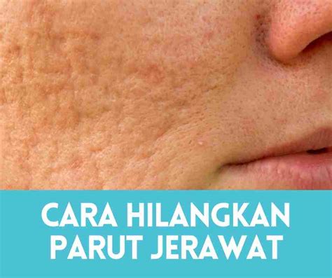 Cara Hilangkan Parut Berlubang Cara Hilangkan Parut Jerawat Berlubang