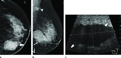 Invasive Ductal Carcinoma Mammogram