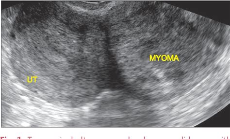 [pdf] A Case Of Torsion Of A Subserosal Leiomyoma Semantic Scholar