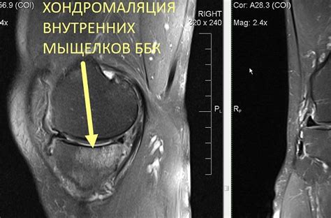МРТ коленного сустава на 15-канальной катушке