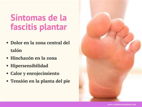 Fascitis Plantar Causas Síntomas y Tratamiento