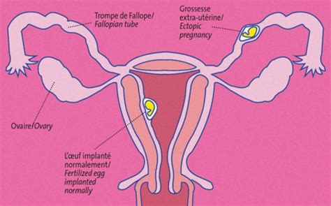Grossesse Extra Ut Rine Neufmois Fr
