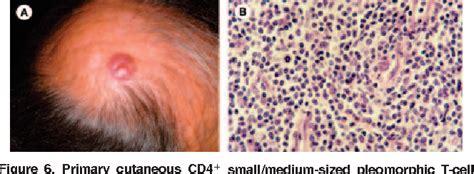 Table 2 From WHO EORTC Classification For Cutaneous Lymphomas