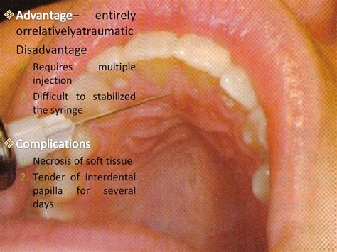 maxillary nerve blocks