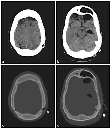 Ct Of The Head A B Ct Brain Windows Showing Pneumocephalus Anterior