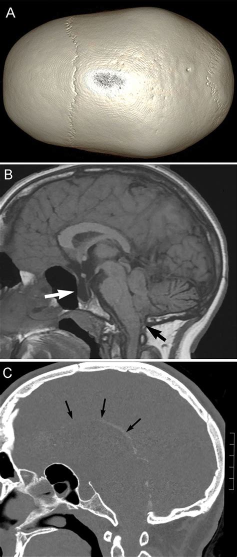 Head And Brain Anomalies A Three Dimensional Reconstruction Computed