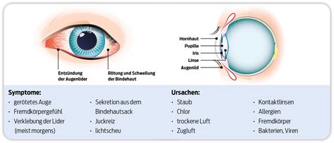 Bindehautentzündung Konjunktivitis Entzündung am Auge Similasan