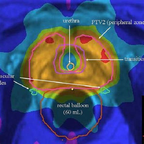 Dose Distribution In The Axial Plane Of An Endorectal Magnetic