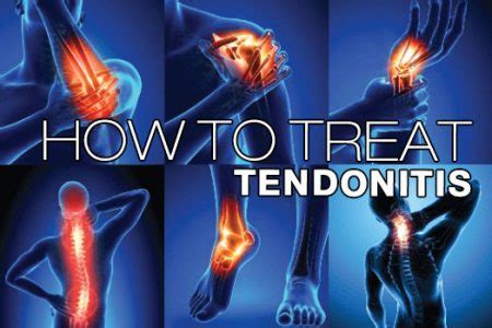 Tendonitis: Symptoms, Causes, Treatment By Tendonitis Braces