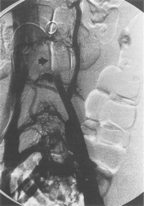 Figure 1 from Iliac Vein Compression Syndrome: A New Method of ...