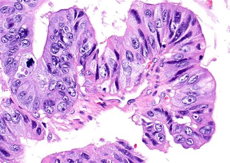 Pathology Outlines Mucinous Borderline Tumor