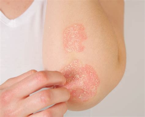 5 Things You Need To Know About Psoriasis Osler Health