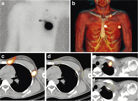 99mtc Nanocolloid Spect Ct In Sentinel Node Lymphoscintigraphy