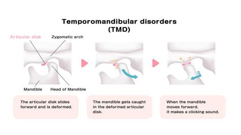 Gangguan Temporomandibular TMJ Penyebab Dan Pengobatan Untuk