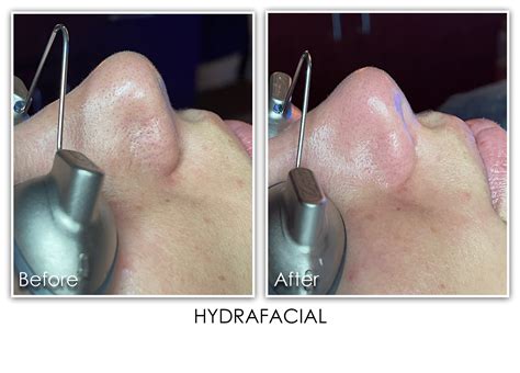 Hydrafacial Archives Skin Rejuvenation Clinic Skin Rejuvenation Clinic