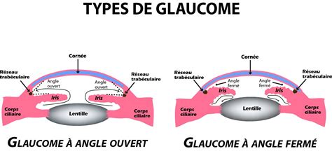 Glaucome Causes Symptômes et Traitements Information hospitalière