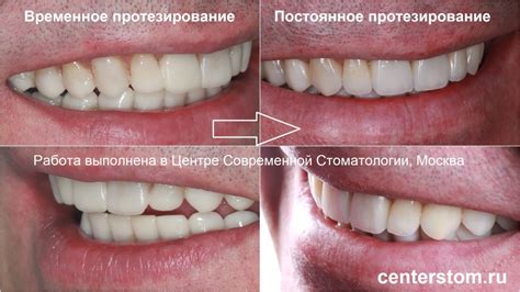 Виниры из керамики и композита имеют огромную разницу. Но так ли она ...