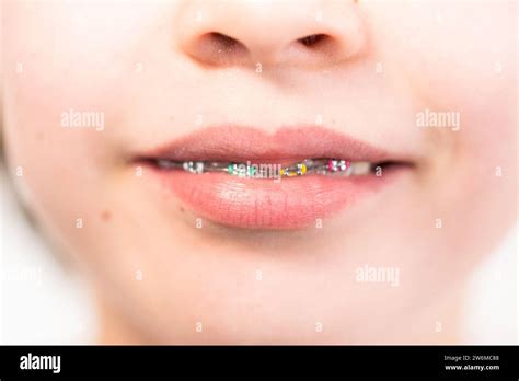 Little girl with rainbow braces Stock Photo - Alamy