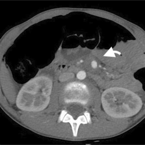 Abdominal Contrast Enhanced Ct Arterial Phase Axial Scan Sma Download Scientific Diagram